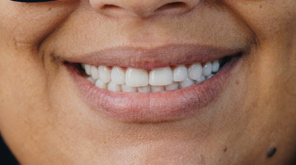 Sonrisa de paciente con diseño en resina